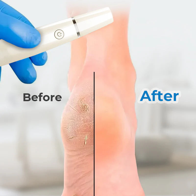 ⚡Electric Feet Callus Remover