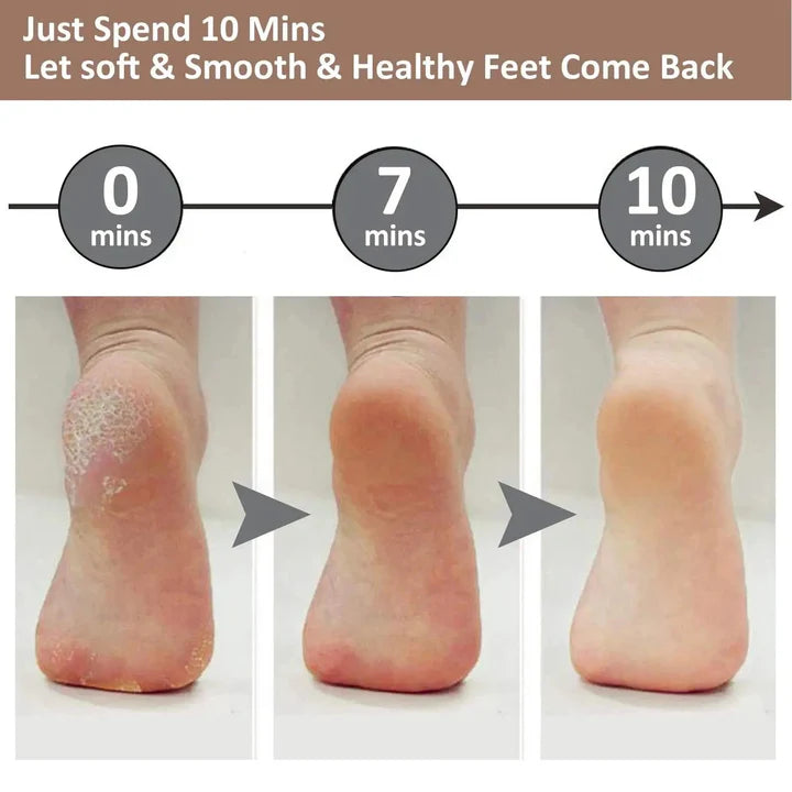 Dead Skin Feet & Callus Remover